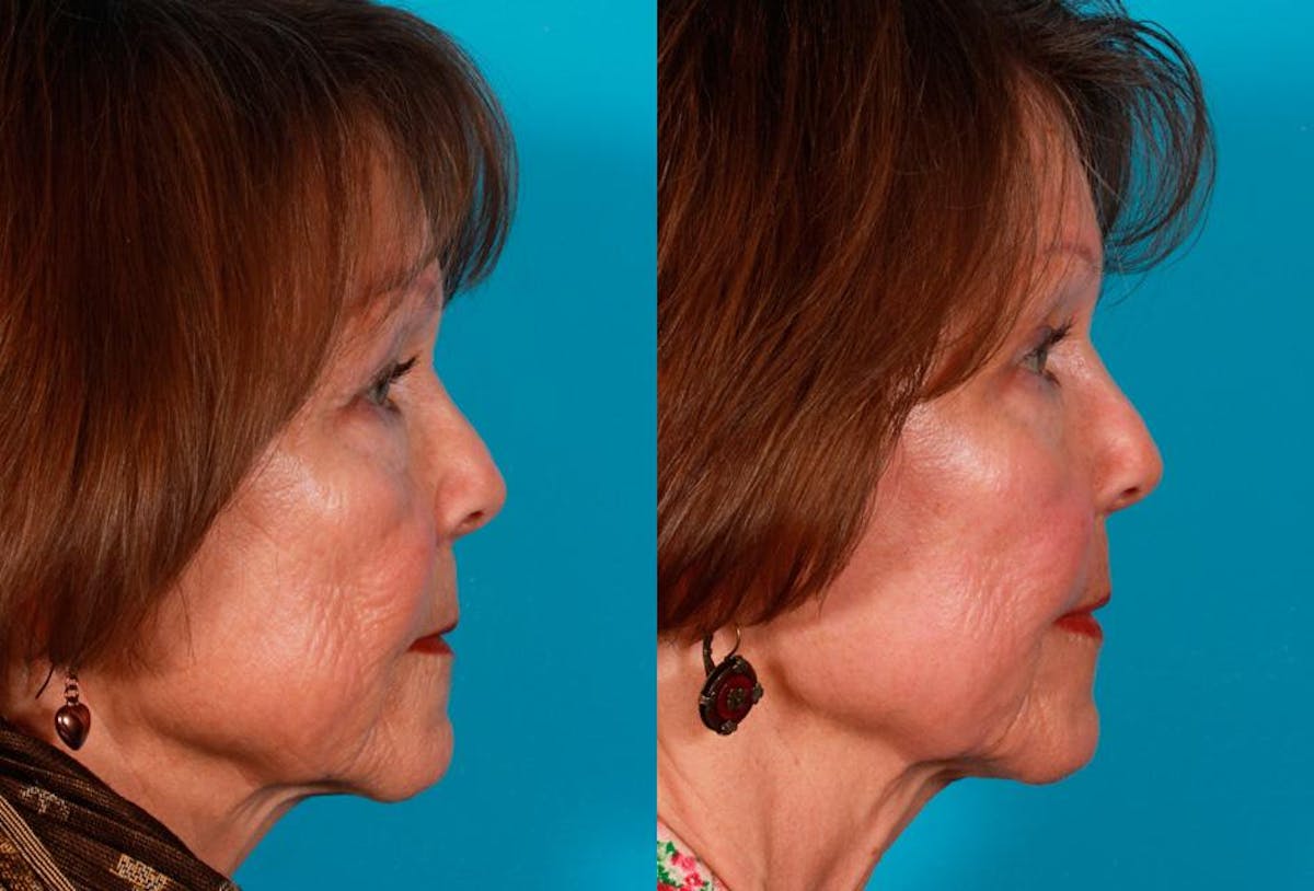 Fractional Laser Before & After Gallery - Patient 424988 - Image 3