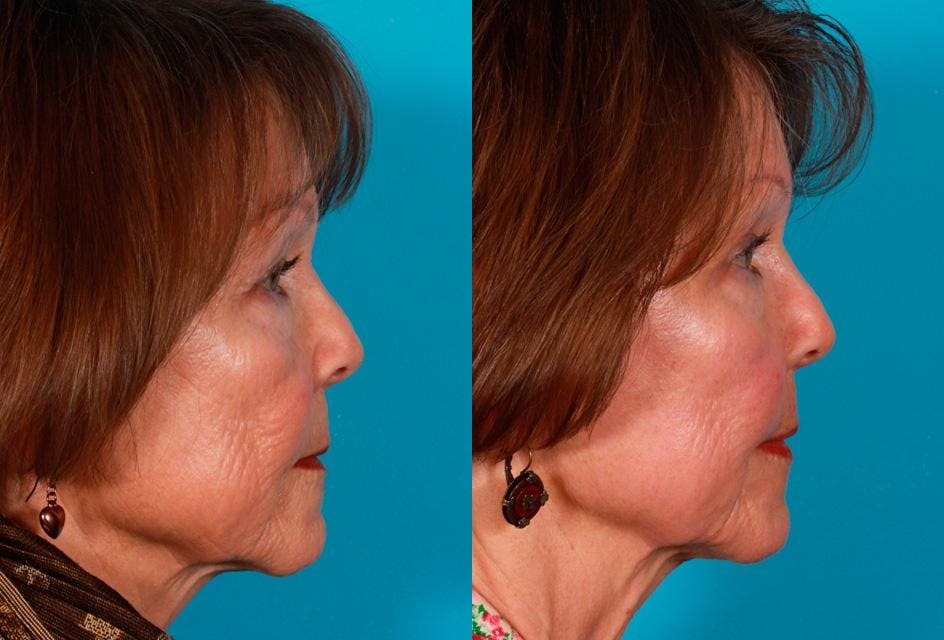 CO2 Fractional Laser Before & After Gallery - Patient 424988 - Image 3