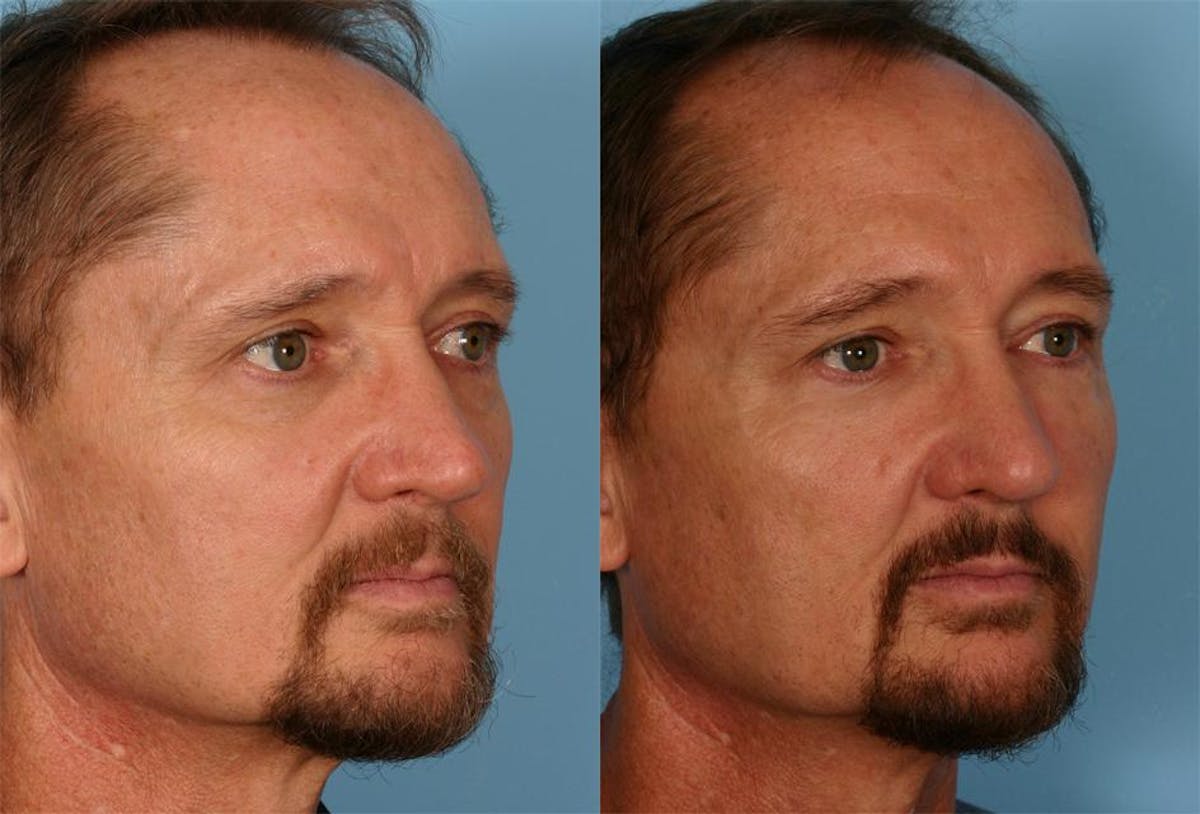 Facial Fat Transfer Before & After Gallery - Patient 421566 - Image 2