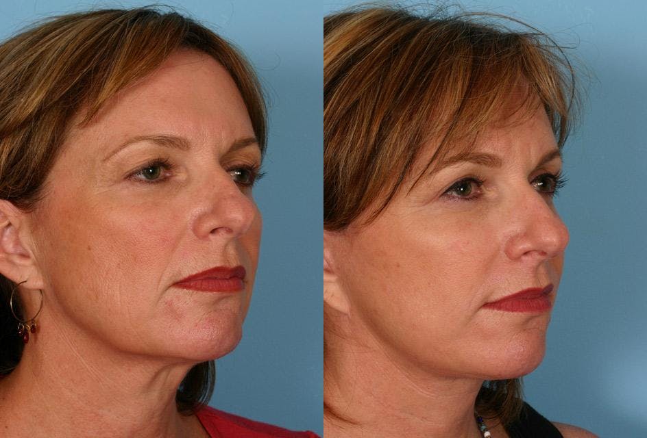Facelift Before & After Gallery - Patient 332223 - Image 2