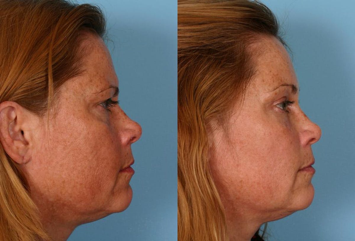 Endoscoplic Browlift Before & After Gallery - Patient 370813 - Image 3