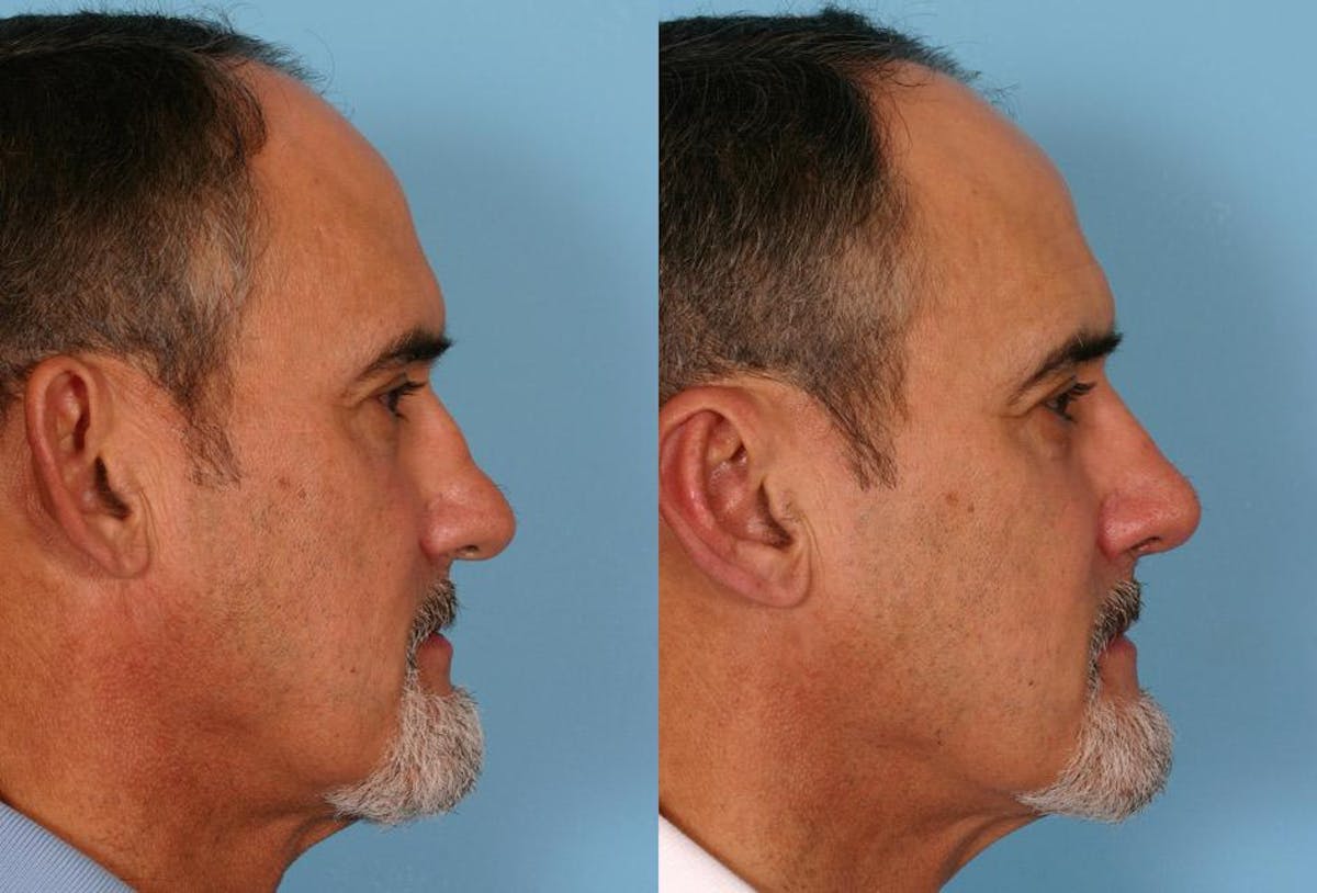 Ear Surgery (Otoplasty) Before & After Gallery - Patient 367756 - Image 2