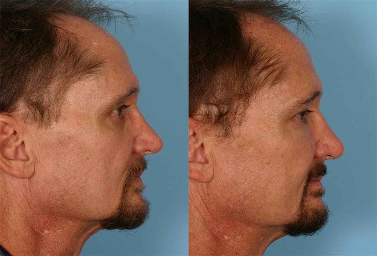 Facial Fat Transfer Before & After Gallery - Patient 421566 - Image 3