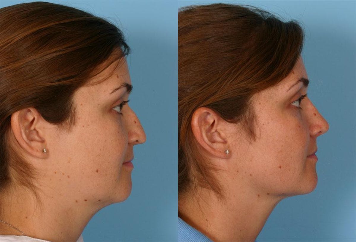 Nasal Obstruction Before & After Gallery - Patient 259126 - Image 2