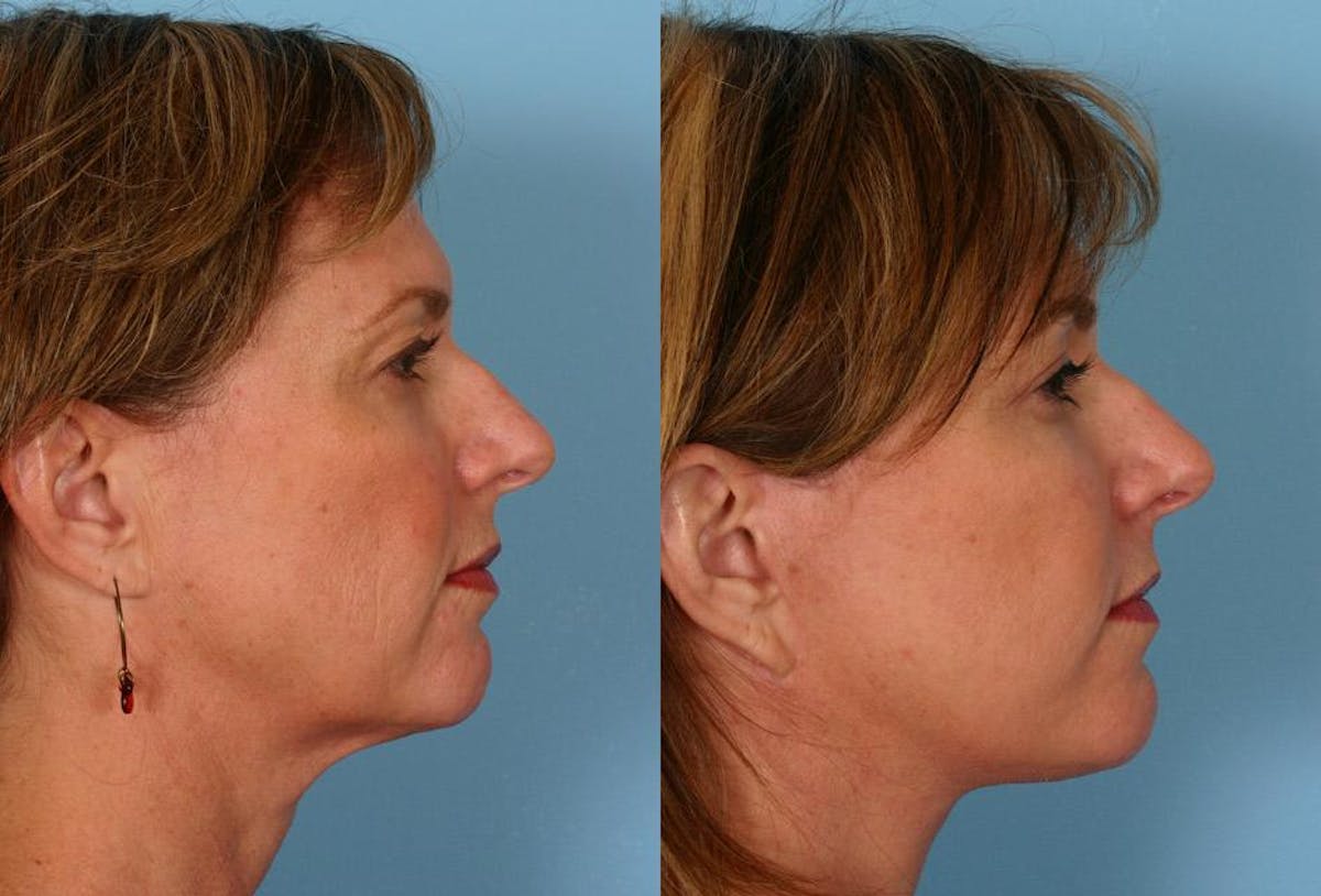 Facelift Before & After Gallery - Patient 332223 - Image 3