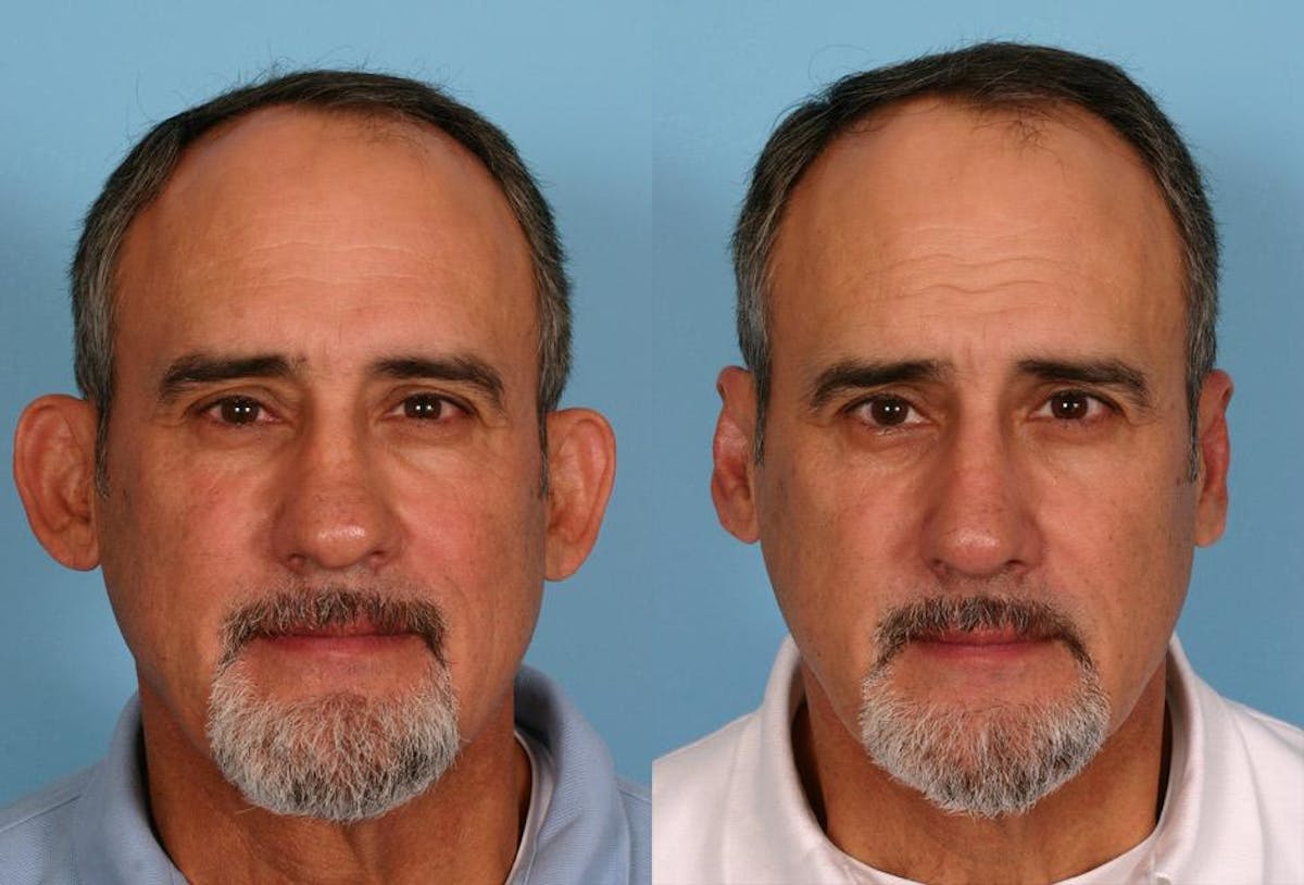 Ear Surgery (Otoplasty) Before & After Gallery - Patient 367756 - Image 3