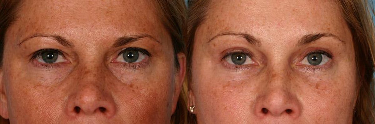 Endoscoplic Browlift Before & After Gallery - Patient 370813 - Image 4