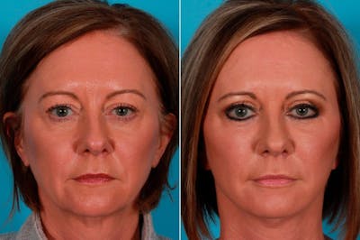 CO2 Fractional Laser Before & After Gallery - Patient 306188 - Image 1