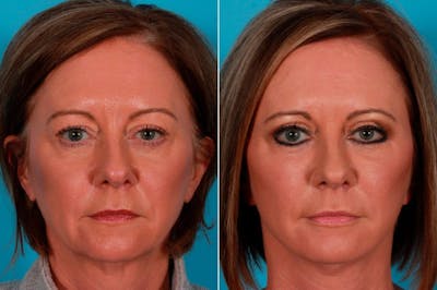 Fractional Laser Before & After Gallery - Patient 306188 - Image 1