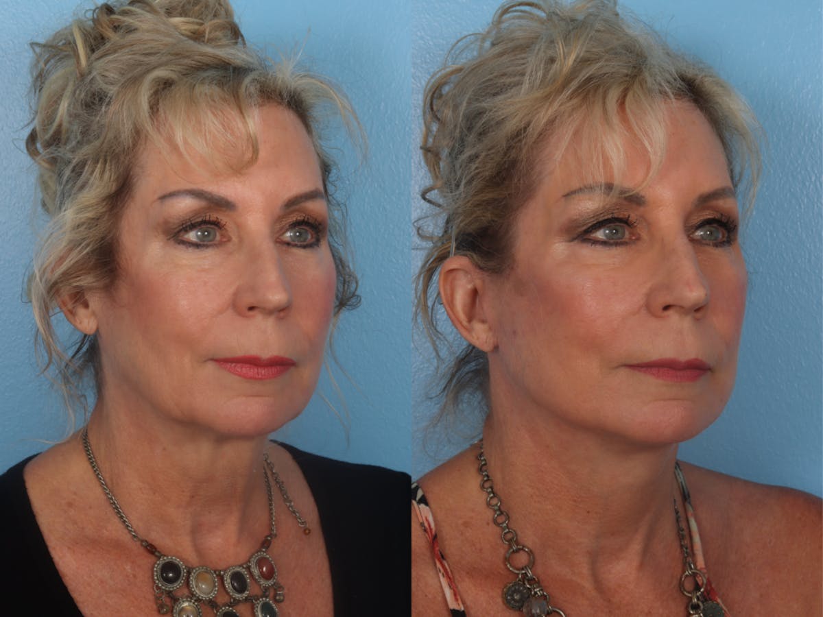 Limited Incision Facelift Before & After Gallery - Patient 363758 - Image 2