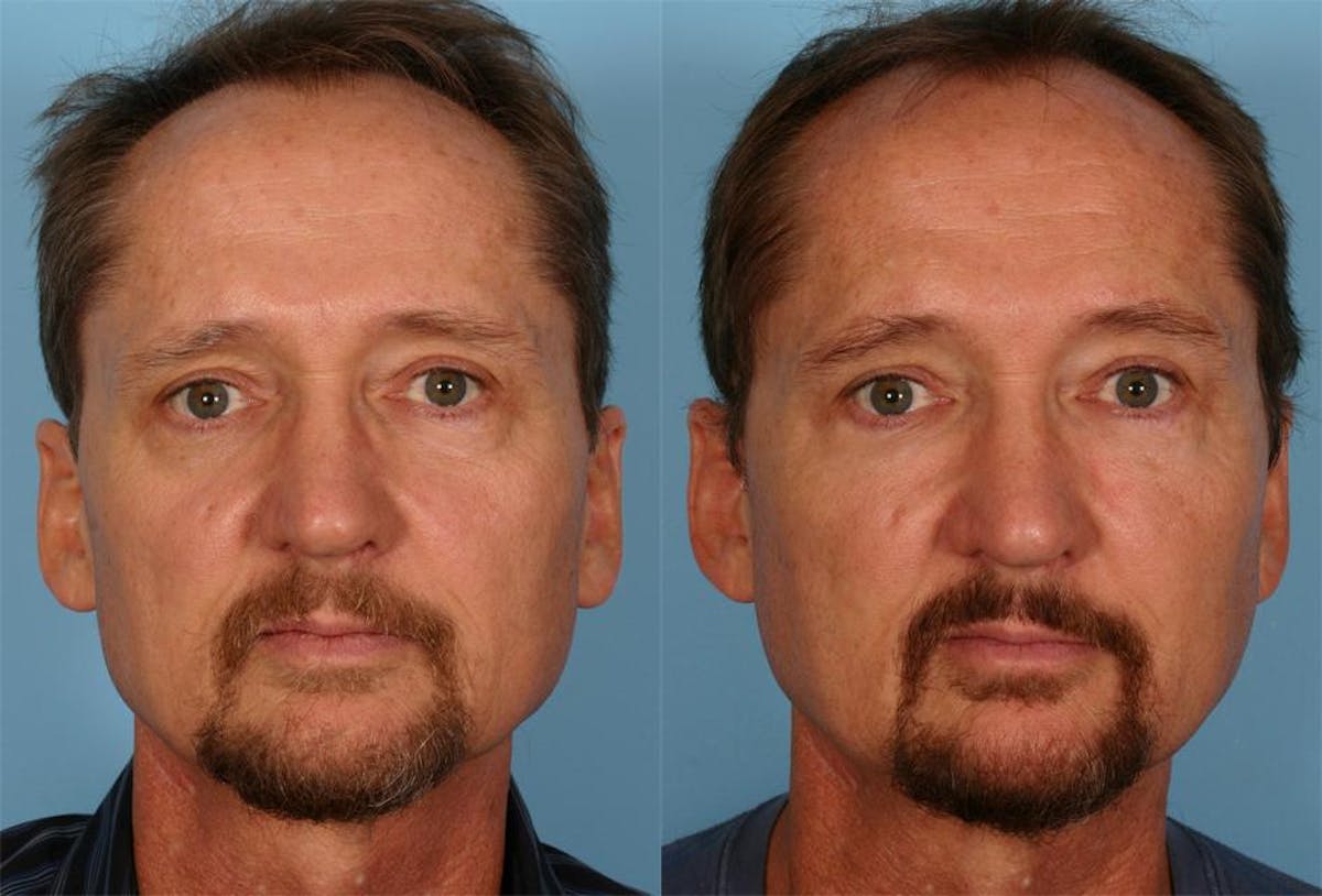 Facial Fat Transfer Before & After Gallery - Patient 421566 - Image 4