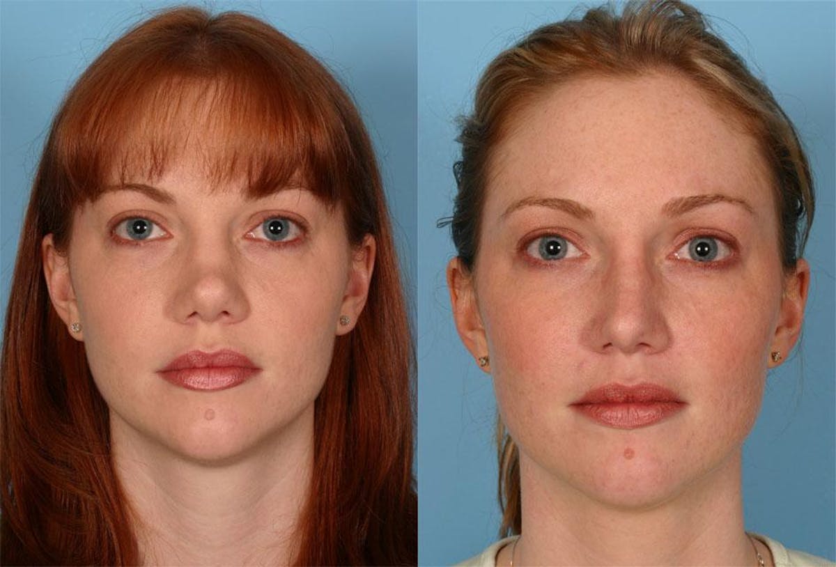 Nasal Obstruction Before & After Gallery - Patient 419637 - Image 1