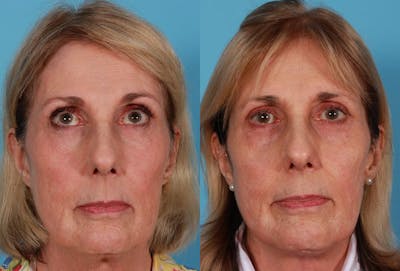 Necklift Before & After Gallery - Patient 264171 - Image 1