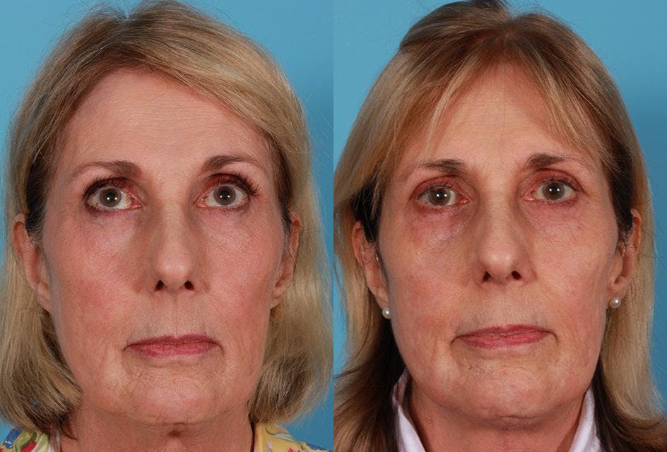 Neck Lift Before & After Gallery - Patient 264171 - Image 1