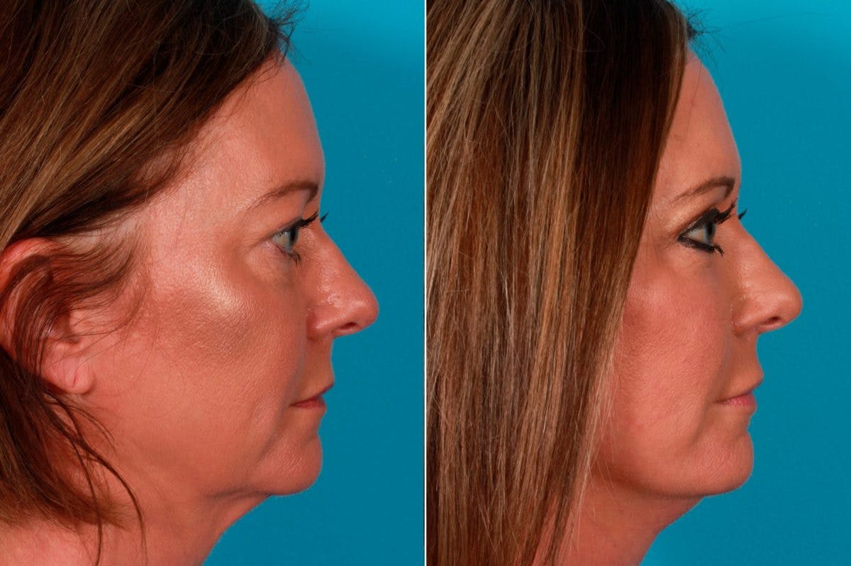 CO2 Fractional Laser Before & After Gallery - Patient 306188 - Image 2