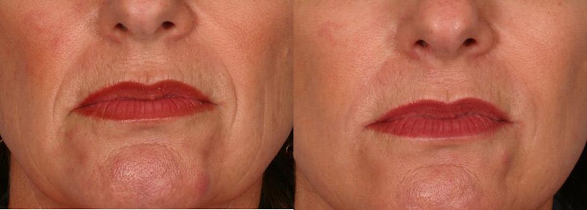 Facelift Before & After Gallery - Patient 332223 - Image 5