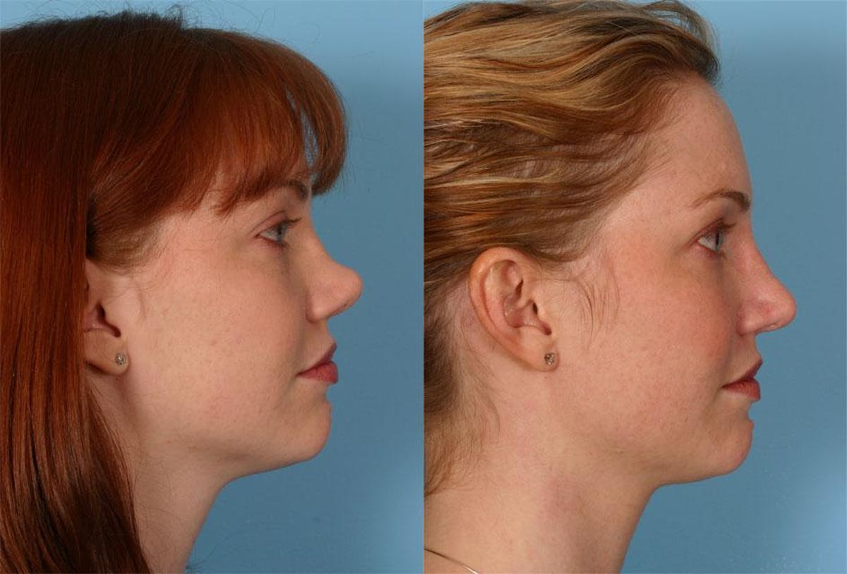 Nasal Obstruction Before & After Gallery - Patient 419637 - Image 2