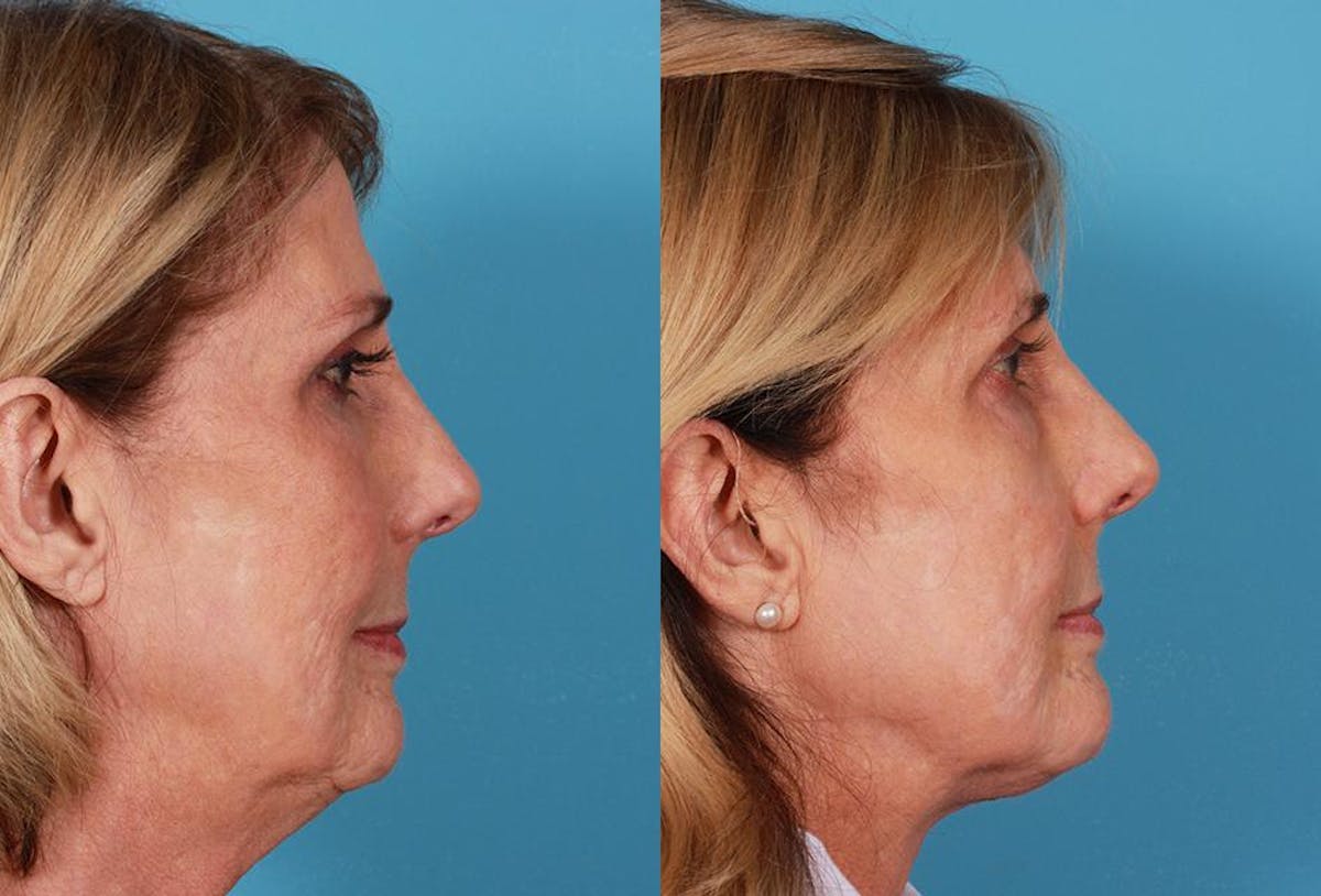 Necklift Before & After Gallery - Patient 264171 - Image 2