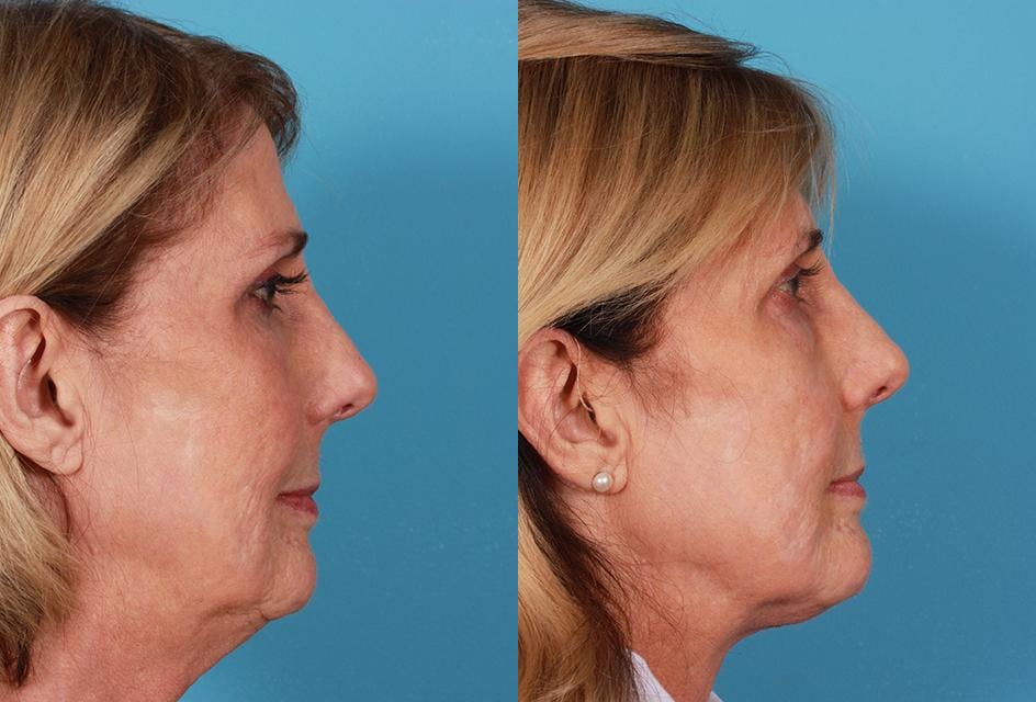 Neck Lift Before & After Gallery - Patient 264171 - Image 2