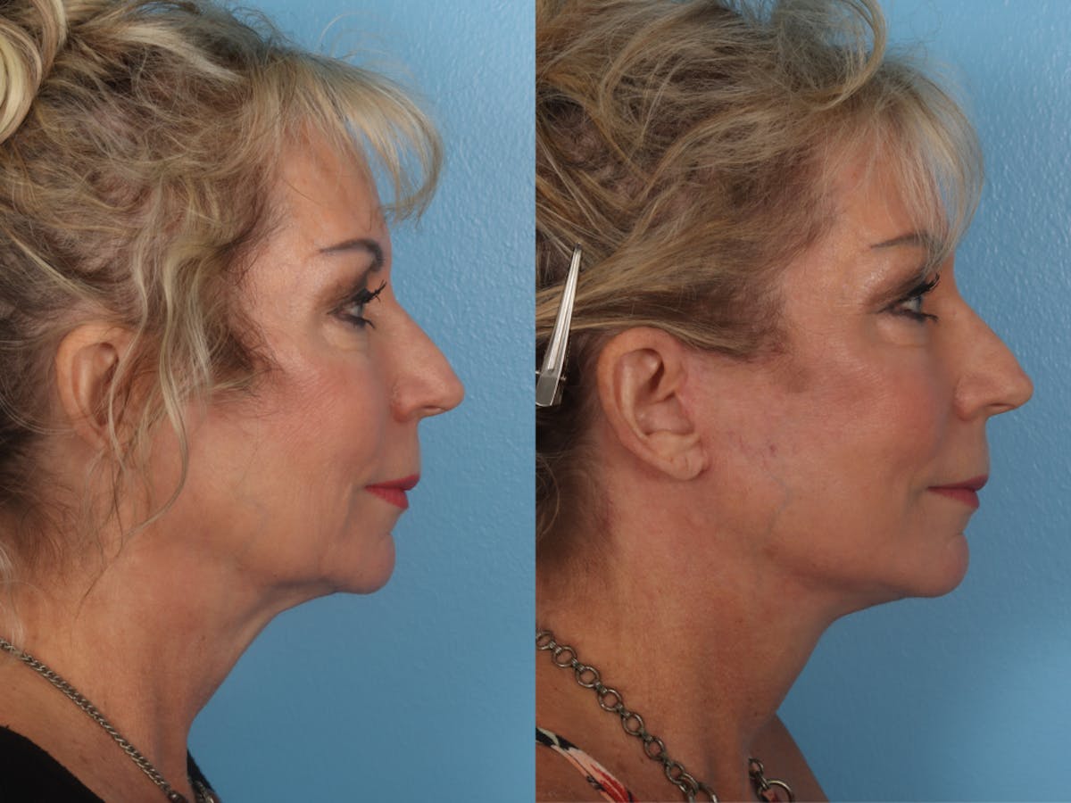 Limited Incision Facelift Before & After Gallery - Patient 363758 - Image 3