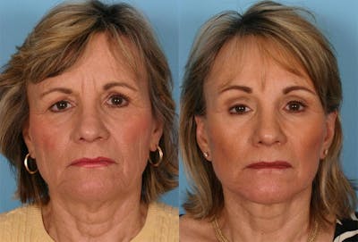 Endoscoplic Browlift Before & After Gallery - Patient 107412 - Image 1