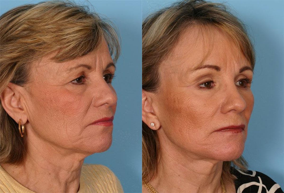 Endoscoplic Browlift Before & After Gallery - Patient 107412 - Image 2