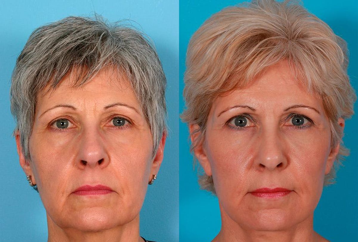 Facial Fat Transfer Before & After Gallery - Patient 953114 - Image 1