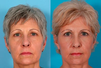 Facial Fat Transfer Before & After Gallery - Patient 953114 - Image 1