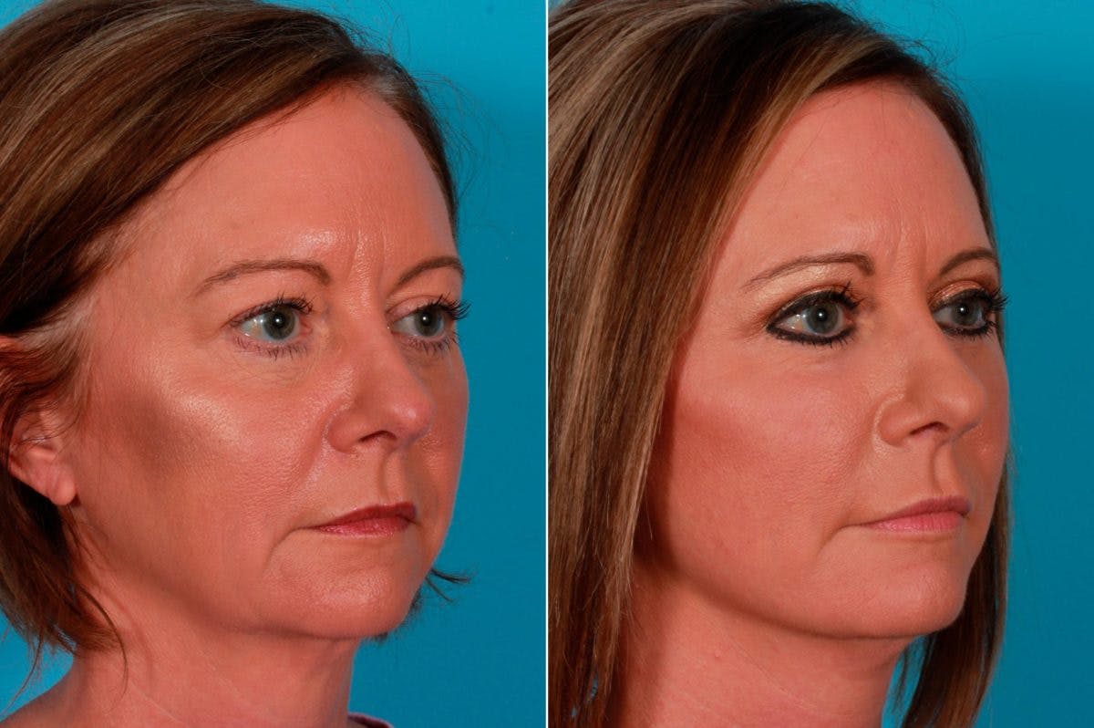 Fractional Laser Before & After Gallery - Patient 306188 - Image 3