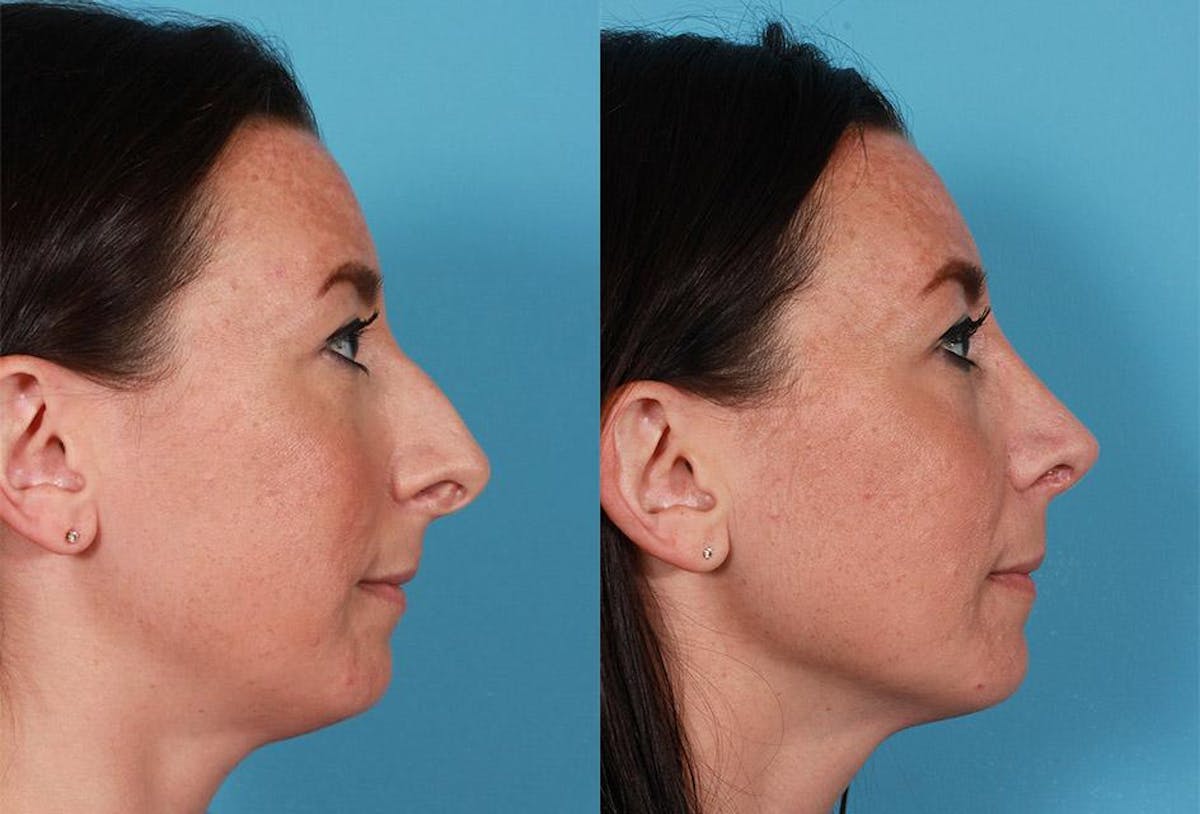 Nasal Obstruction Before & After Gallery - Patient 307097 - Image 2