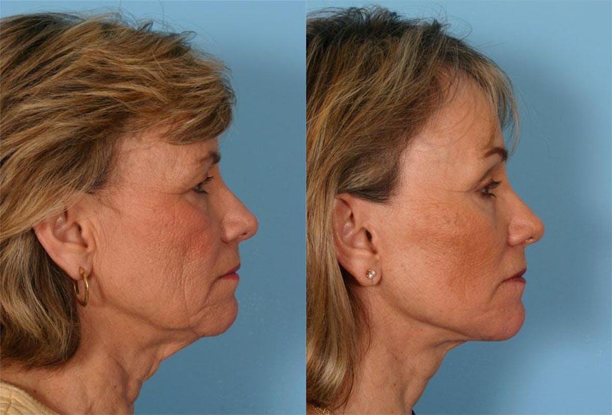Endoscoplic Browlift Before & After Gallery - Patient 107412 - Image 3