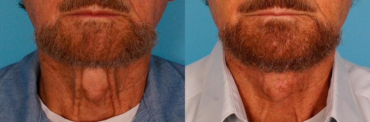 Necklift Before & After Gallery - Patient 399186 - Image 1