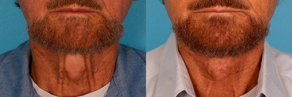 Neck Lift Before & After Gallery - Patient 399186 - Image 1
