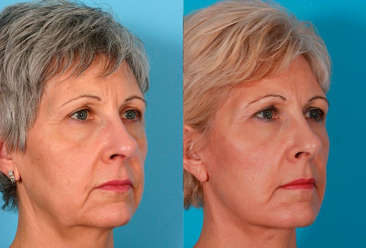 Facial Fat Transfer Before & After Gallery - Patient 953114 - Image 2