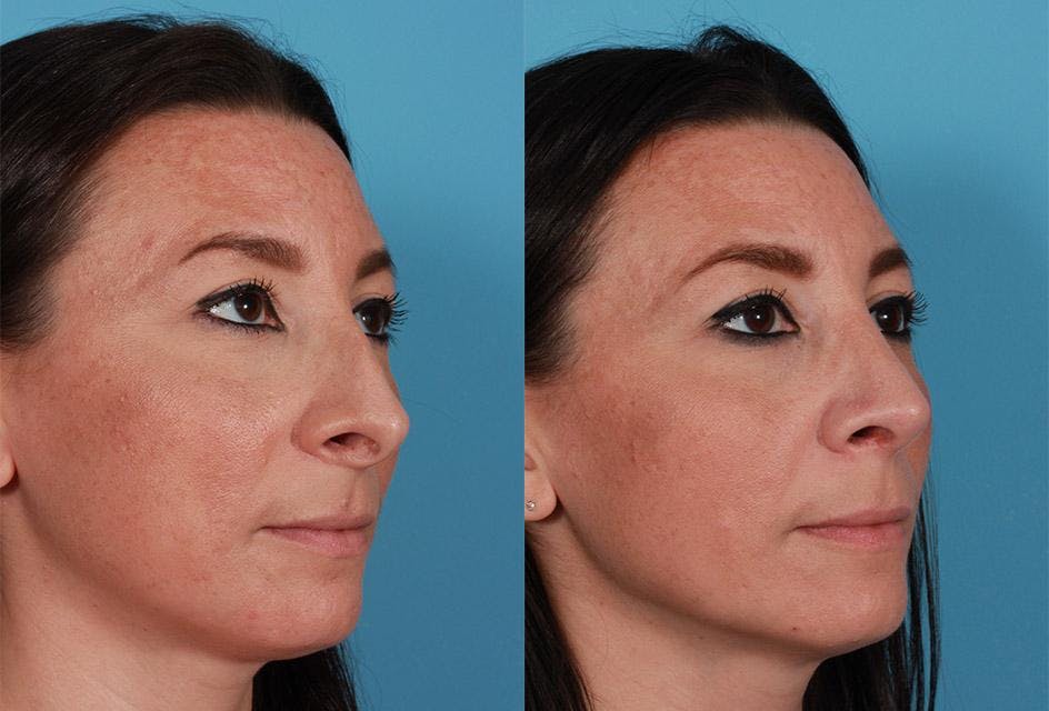 Nasal Obstruction Before & After Gallery - Patient 307097 - Image 3