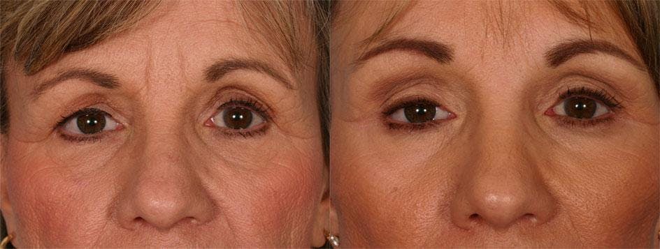 Endoscopic Brow Lift Before & After Gallery - Patient 107412 - Image 4