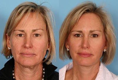 Limited Incision Facelift Before & After Gallery - Patient 353902 - Image 1