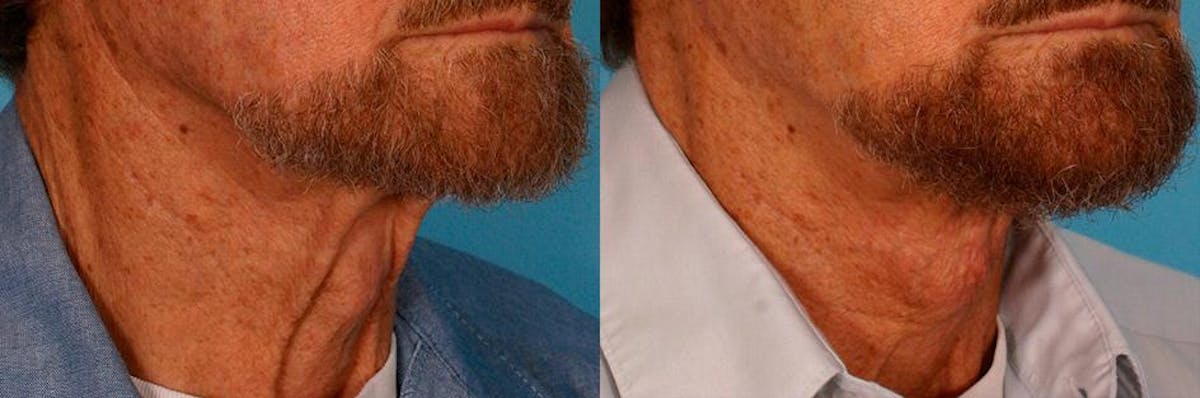 Necklift Before & After Gallery - Patient 399186 - Image 2