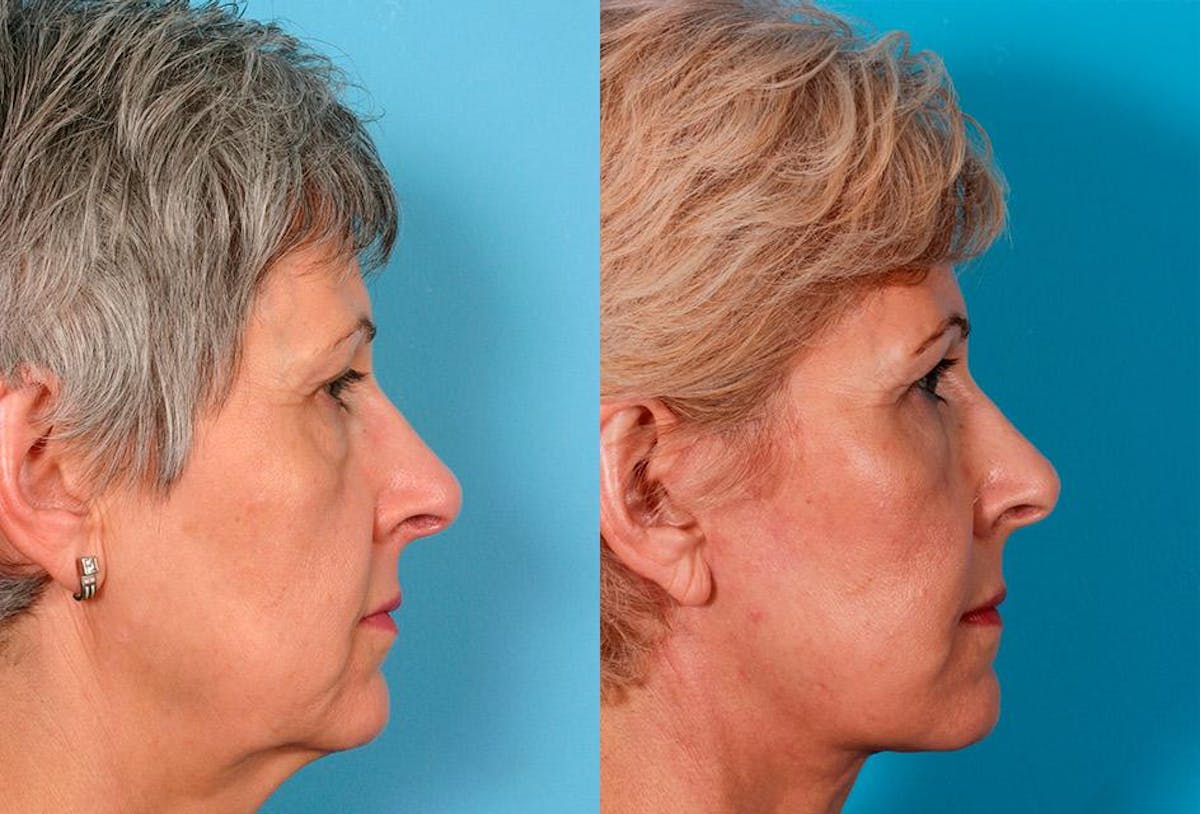 Facial Fat Transfer Before & After Gallery - Patient 953114 - Image 3
