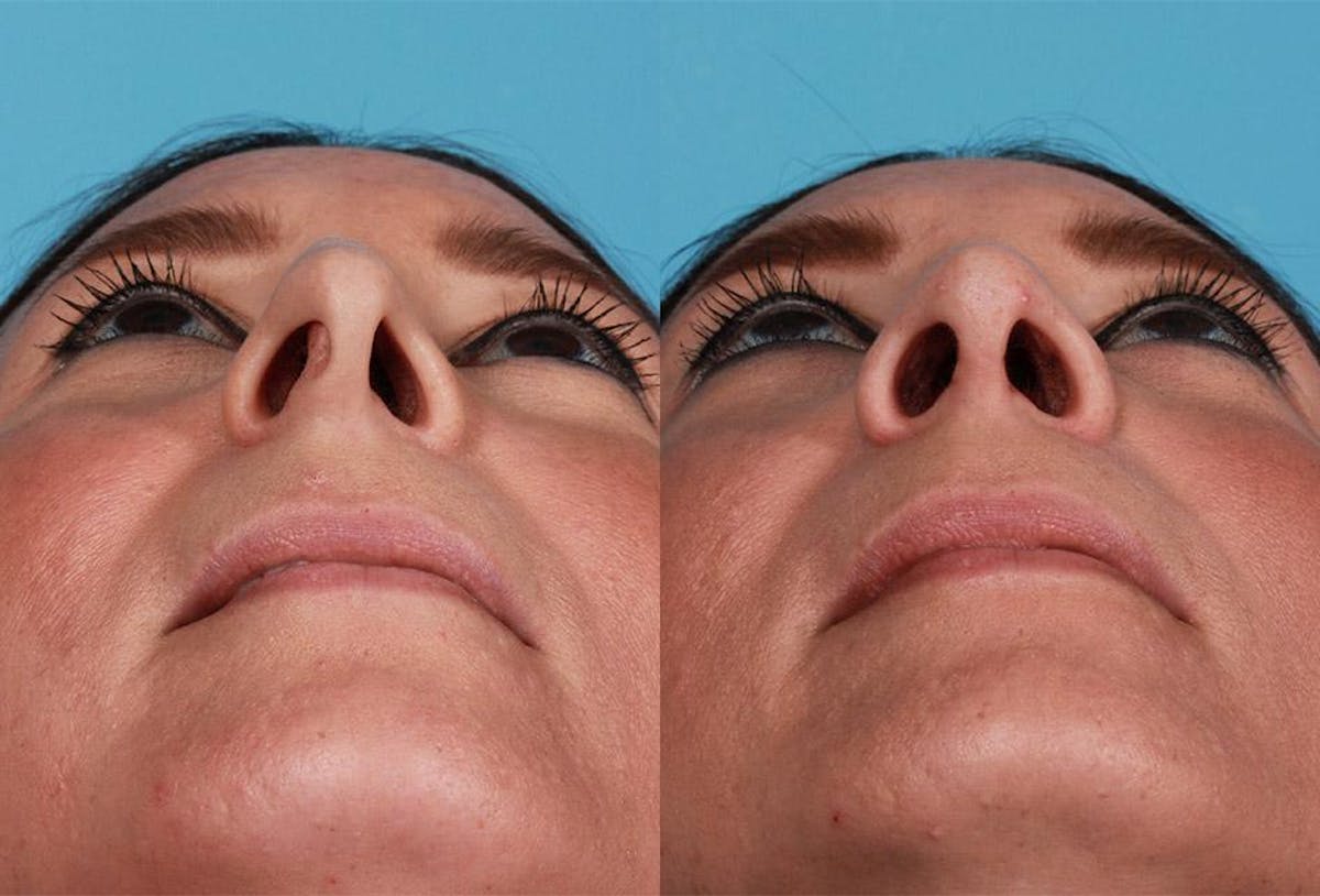 Nasal Obstruction Before & After Gallery - Patient 307097 - Image 4
