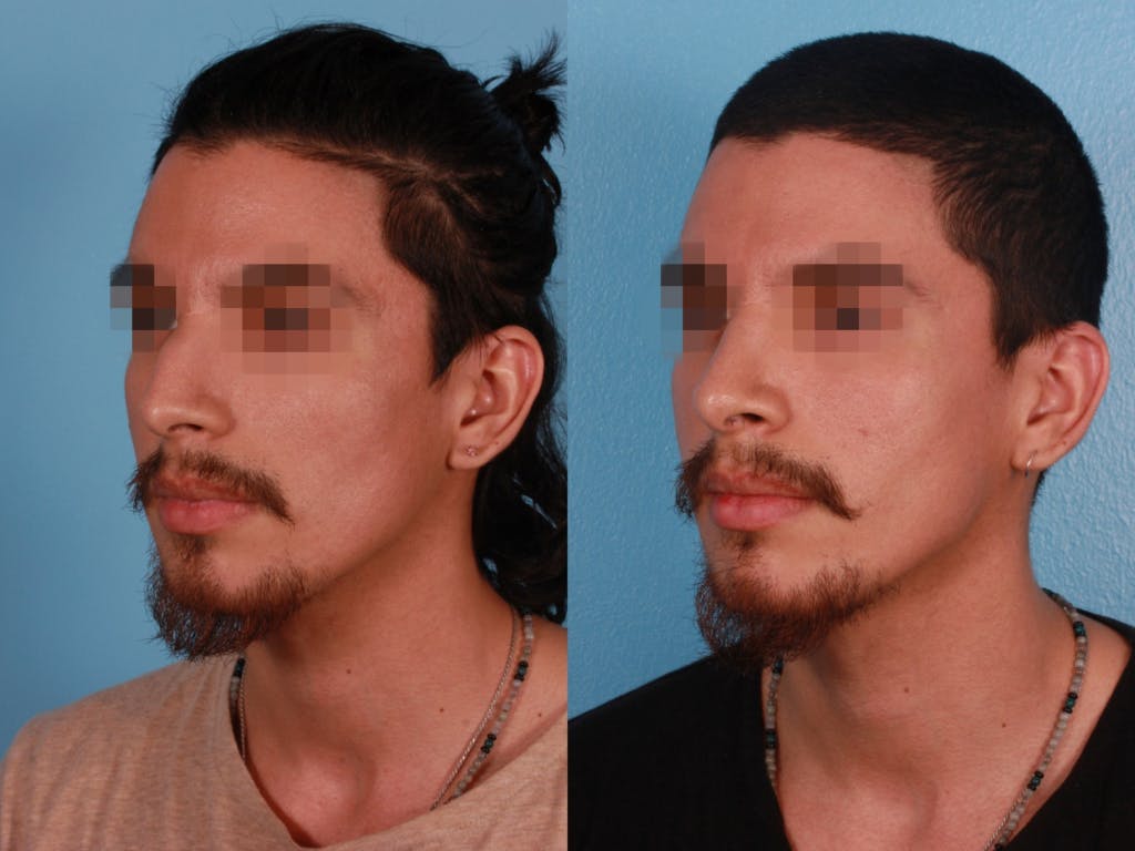 Rhinoplasty Before & After Gallery - Patient 230635 - Image 2