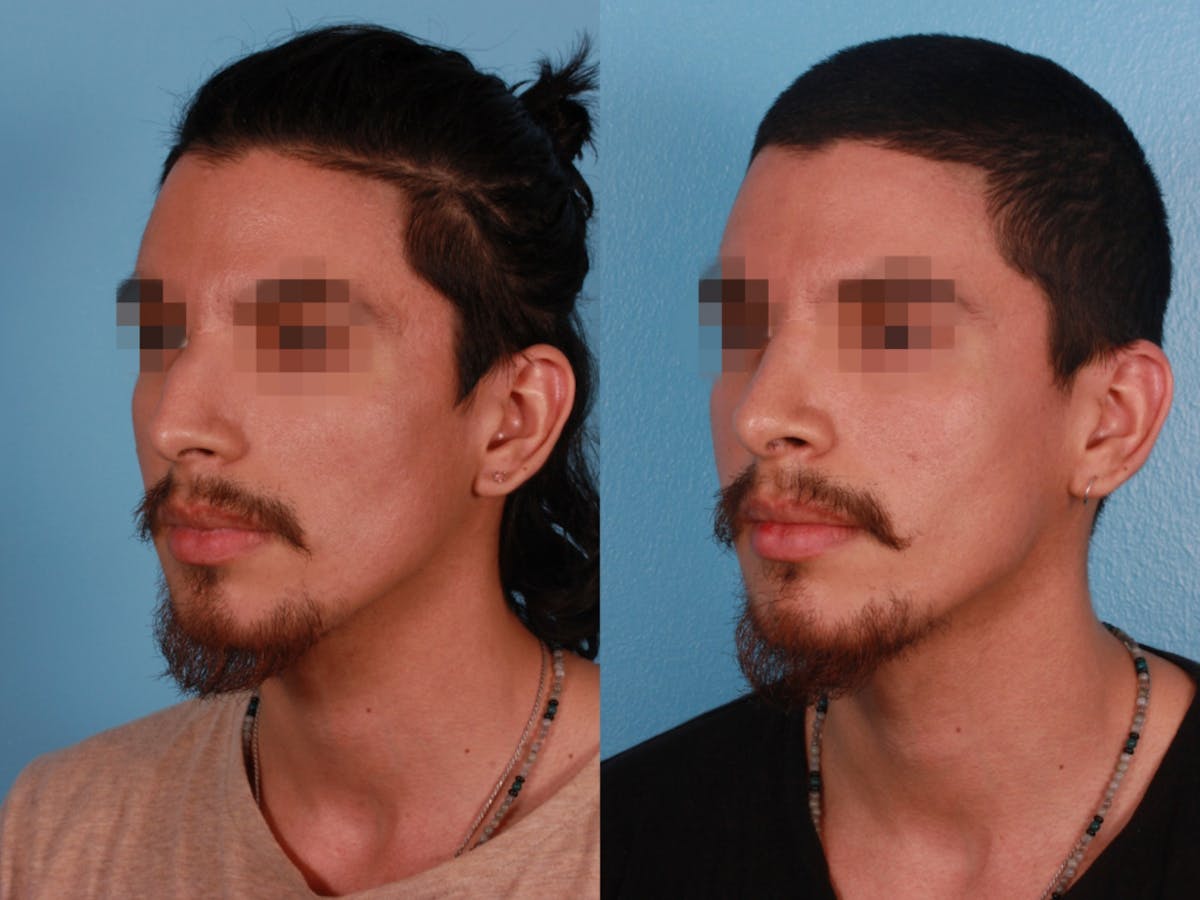 Rhinoplasty Before & After Gallery - Patient 230635 - Image 1