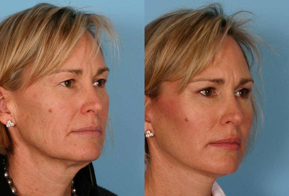 Limited Incision Facelift Before & After Gallery - Patient 353902 - Image 2