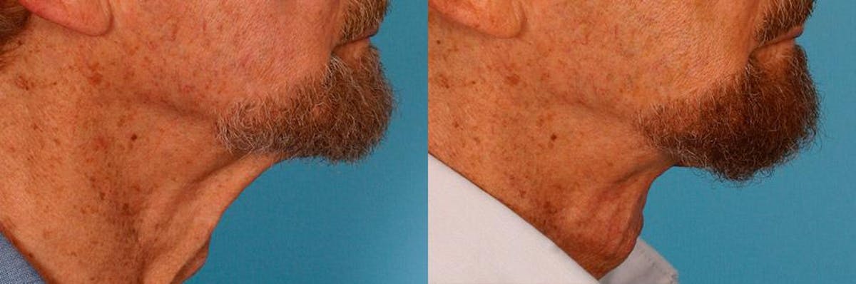 Necklift Before & After Gallery - Patient 399186 - Image 3