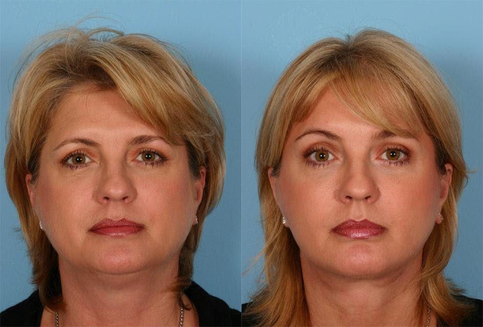 Endoscopic Brow Lift Before & After Gallery - Patient 290149 - Image 1