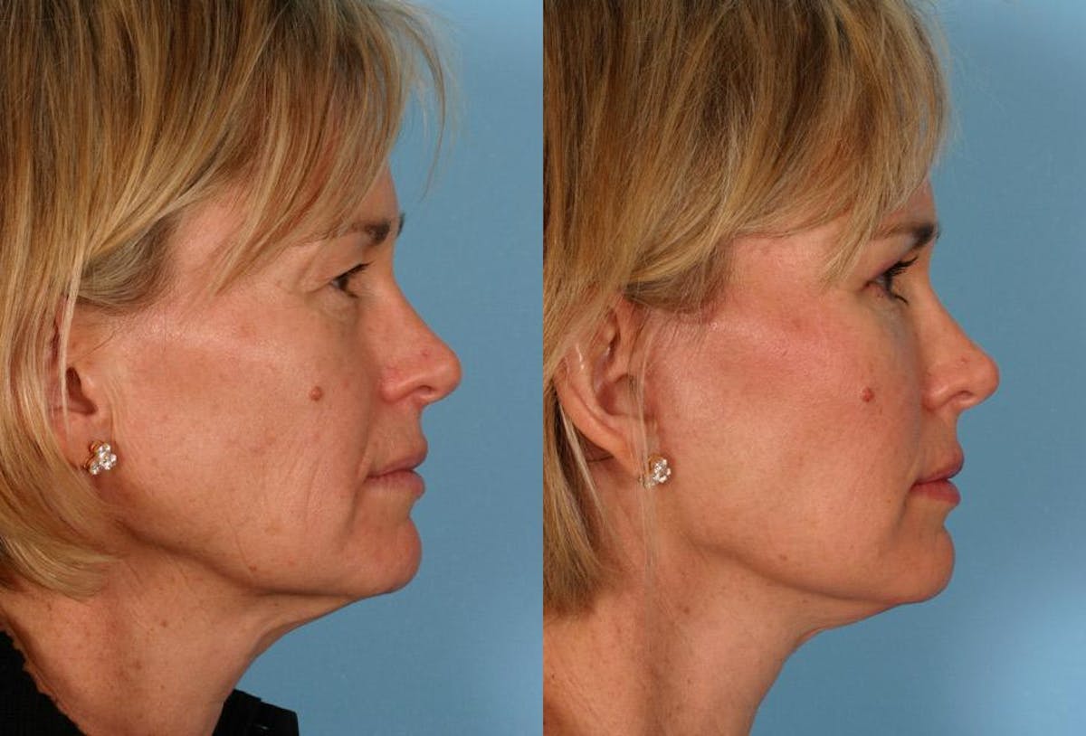 Limited Incision Facelift Before & After Gallery - Patient 353902 - Image 3