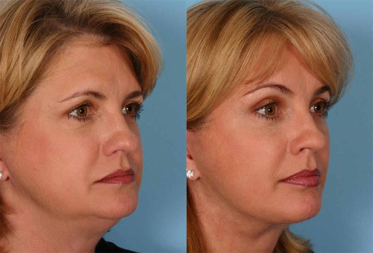 Endoscoplic Browlift Before & After Gallery - Patient 290149 - Image 2