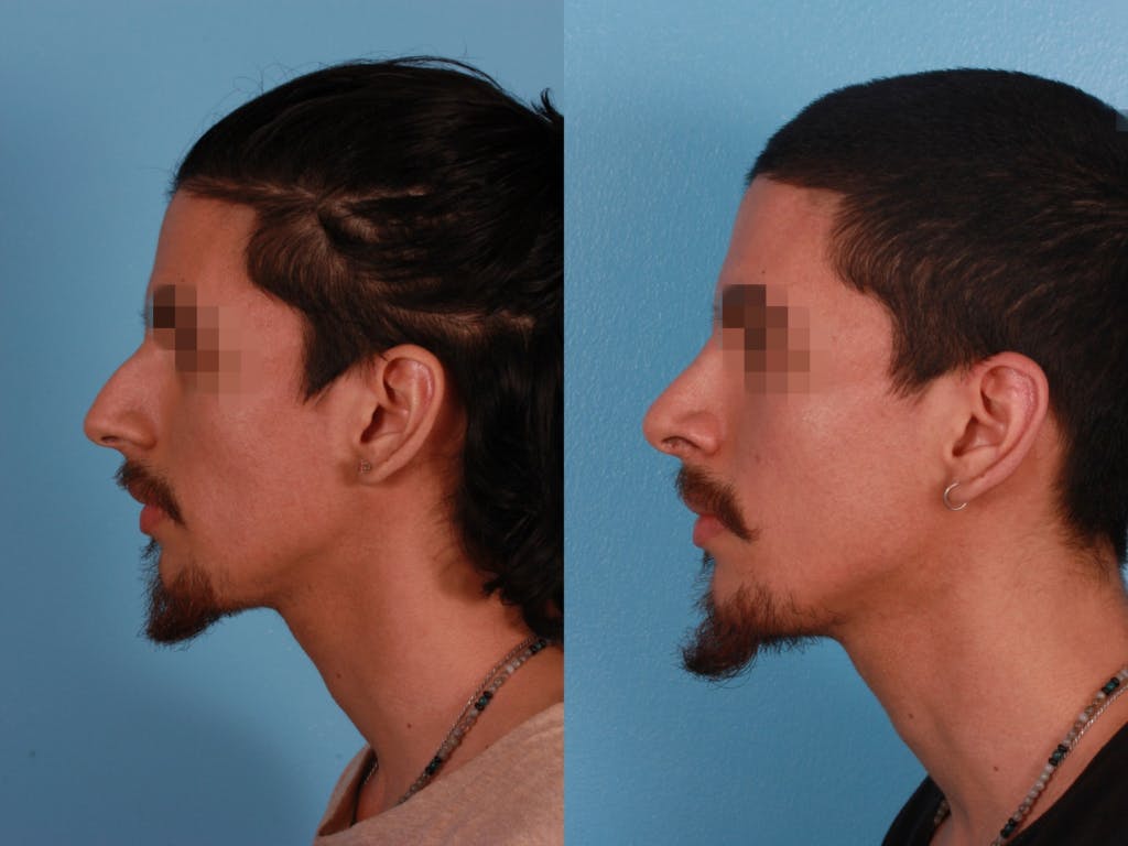 Rhinoplasty Before & After Gallery - Patient 230635 - Image 1