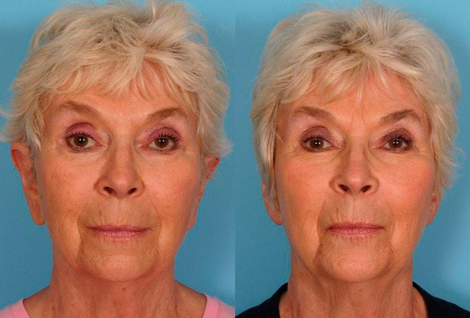 Ear Surgery (Otoplasty) Before & After Gallery - Patient 374305 - Image 1