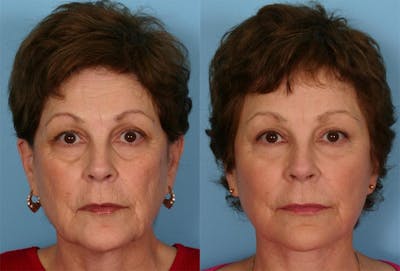 Facial Fat Transfer Before & After Gallery - Patient 308493 - Image 1